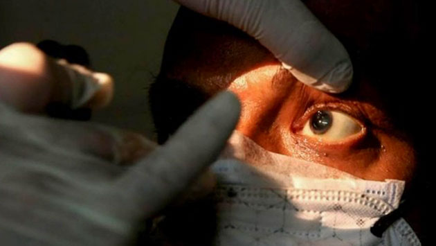 Muere uno de los pacientes sospechosos de tener Hongo Negro en Oaxaca  – Periódico Zócalo | Noticias de Saltillo, Piedras Negras, Monclova, Acuña - Vimarsana News